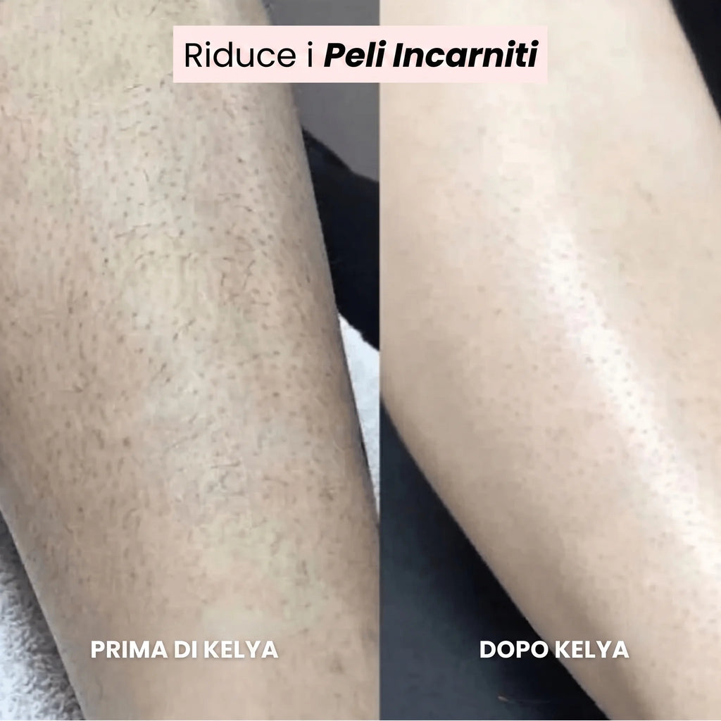 Kelya® – Il trimmer 2 in 1 per pelli sensibili