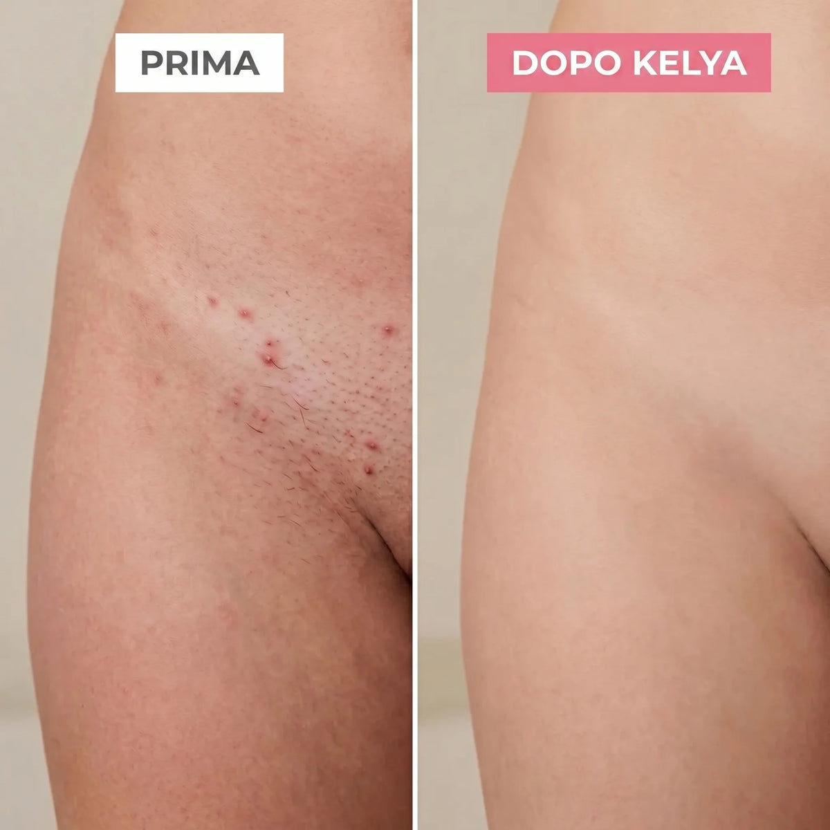 Kelya® – Il trimmer 2 in 1 per pelli sensibili